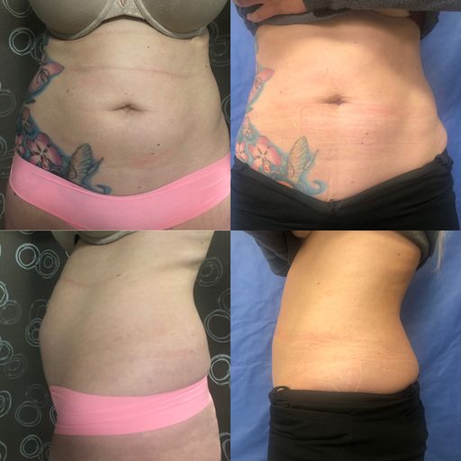 collage of stomach pictures before and after the surgery