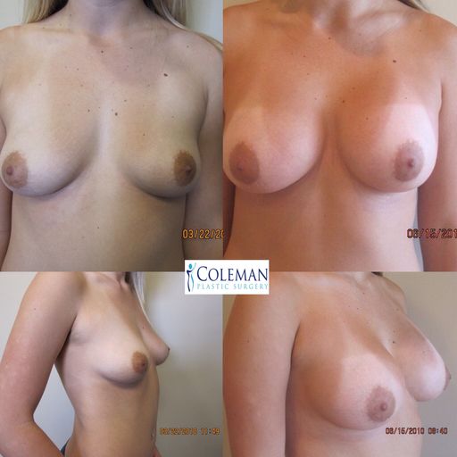collage of four breast pictures with different sizes