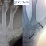 Coleman Plastic Surgery hand x ray