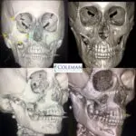 Coleman Plastic Surgery face x ray images