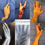 collage of six images of hand surgery