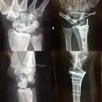 x ray images of the wrist by Coleman Plastic Surgery