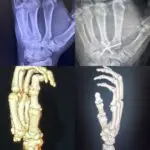 Coleman Plastic Surgery hand x ray images