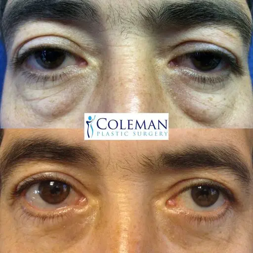 two pictures of eyes before and after the surgery