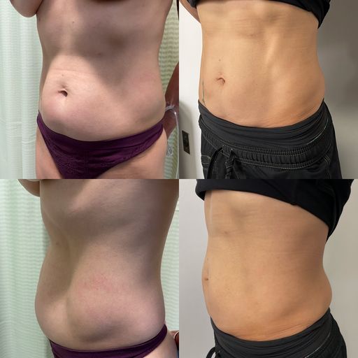 collage of stomach pictures before and after surgery