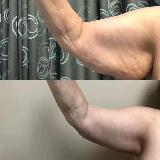 two pictures of the arm before and after the surgery