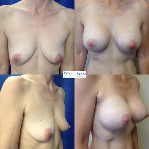 collage of four breast pictures before and after surgery