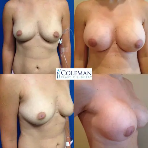 Coleman Plastic Surgery breast pictures with different sizes