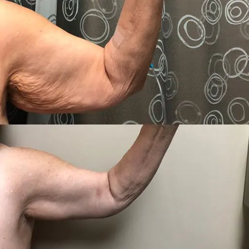 two arm pictures before and after the surgery