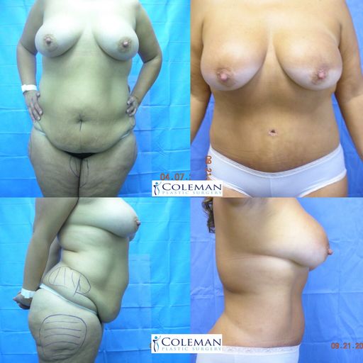 Breast and body pictures before and after surgery