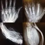 collage of the four hand x ray images