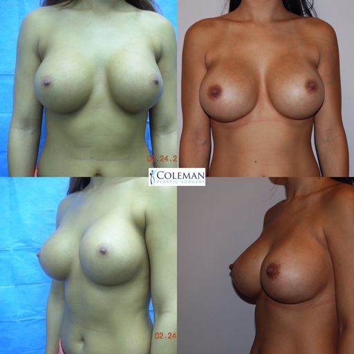 collage of breast pictures with different sizes