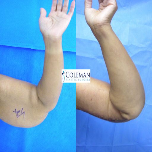 collage of two arm pictures before and after the surgery