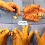 collage of four images of hand surgery
