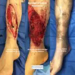 three images of a leg before and after the surgery