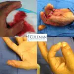 Coleman Plastic Surgery for the finger