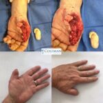 collage of four images of a hand surgery