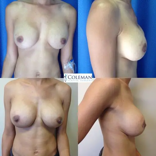 collage of four breast pictures with different sizes