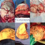 Coleman Plastic Surgery Collage of head Surgery