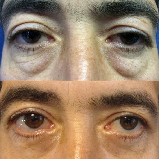 collage of pictures of eyes before and after surgery