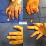 collage of pictures of finger surgery
