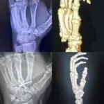 Four x ray images of a hand by Coleman Plastic Surgery